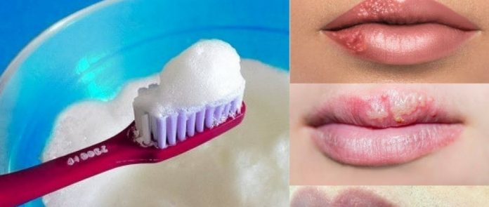 Does Toothpaste help Cold Sores
